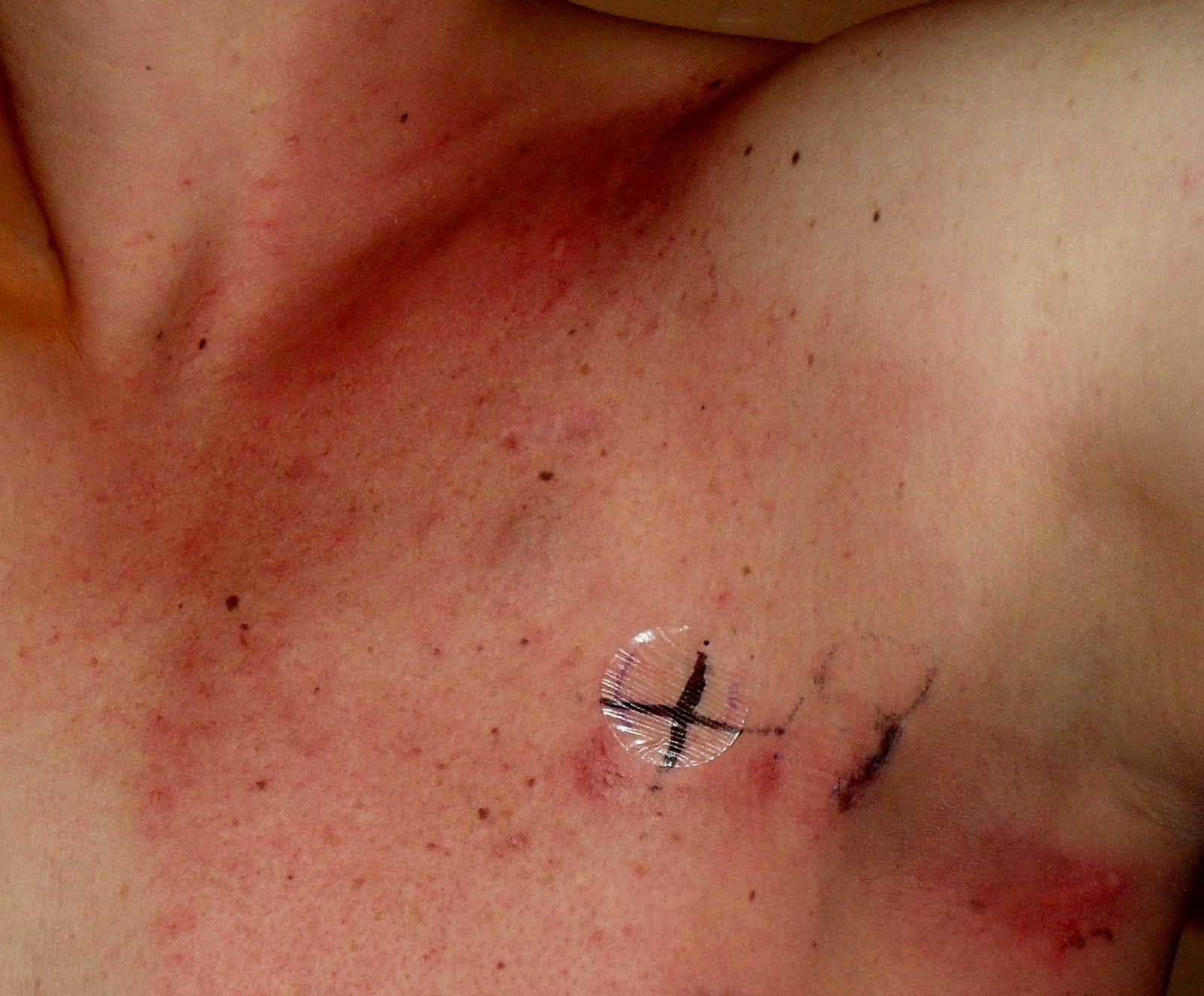 breast cancer radiation burn treatment Sasha cane hardcore